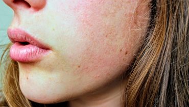can collagen give you acne